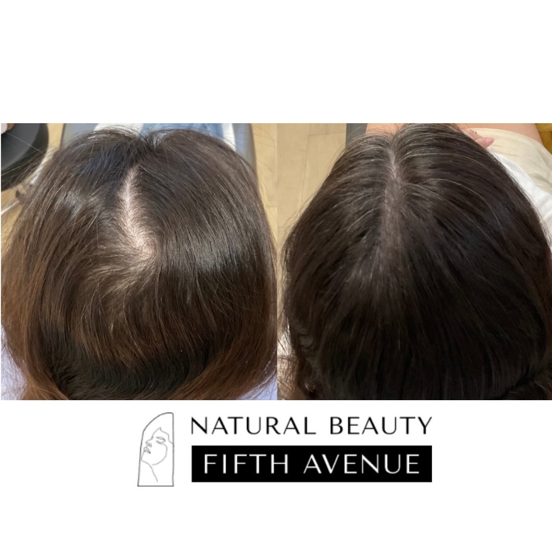 Before and after hair restoration showing increased density and coverage along the scalp part line